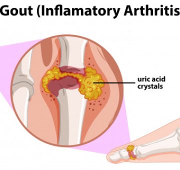 Hiểu sâu hơn về bệnh Gout và cách điều trị hiệu quả