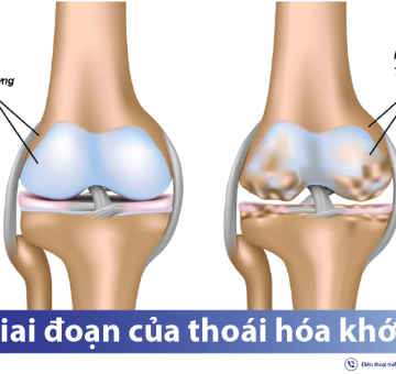 Thoái hóa khớp gối là gì?